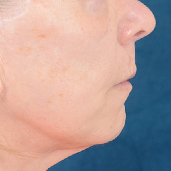Lip Lift Before & After Gallery - Patient 169365984 - Image 5