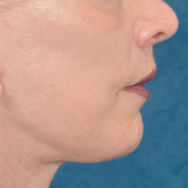 Lip Lift Before & After Gallery - Patient 169365984 - Image 6