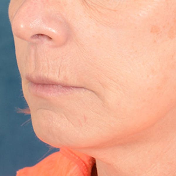 Lip Lift Before & After Gallery - Patient 169365984 - Image 7