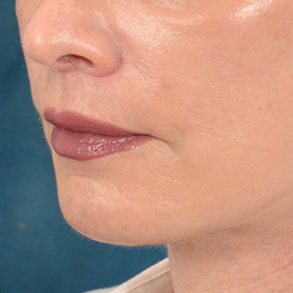 Lip Lift Before & After Gallery - Patient 169365984 - Image 8