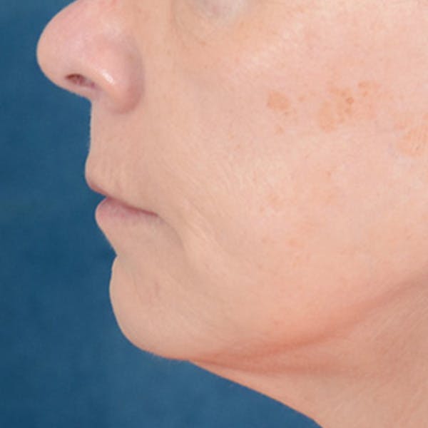 Lip Lift Before & After Gallery - Patient 169365984 - Image 9