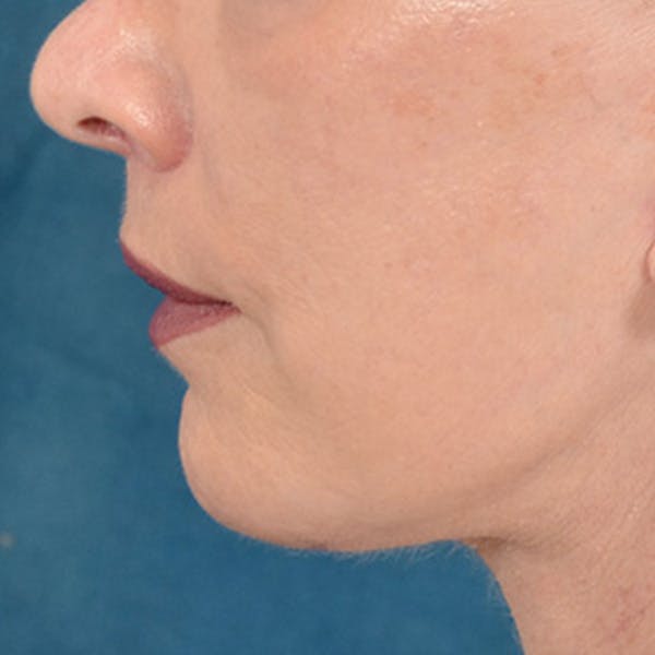 Lip Lift Before & After Gallery - Patient 169365984 - Image 10
