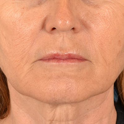 Lip Lift Before & After Gallery - Patient 796520 - Image 1