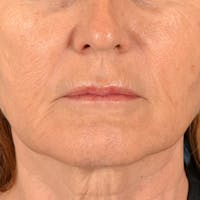 Lip Lift Before & After Gallery - Patient 796520 - Image 1
