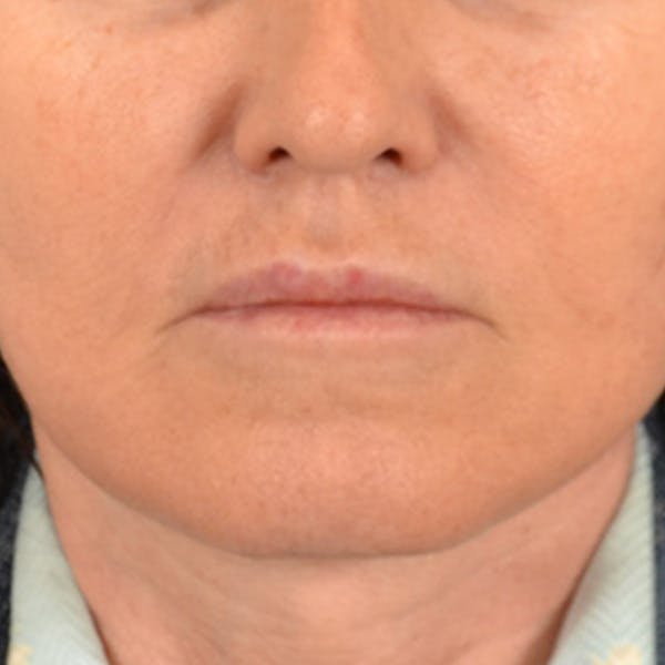Lip Lift Before & After Gallery - Patient 796520 - Image 2