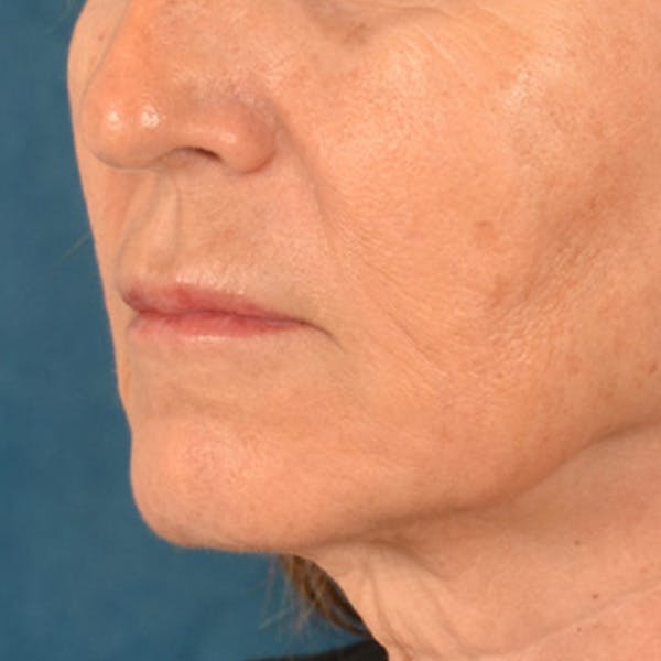 Lip Lift Before & After Gallery - Patient 796520 - Image 3