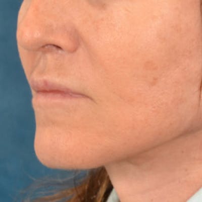 Lip Lift Before & After Gallery - Patient 796520 - Image 4