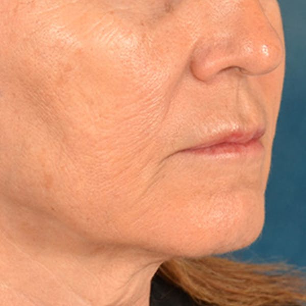 Lip Lift Before & After Gallery - Patient 796520 - Image 5