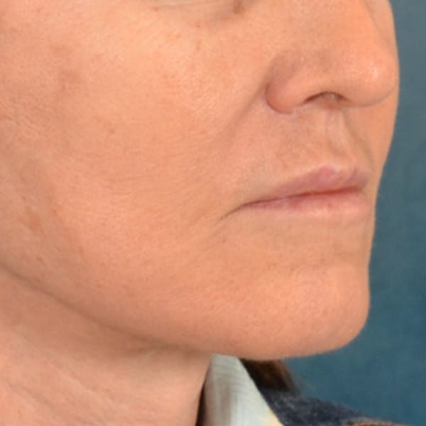 Lip Lift Before & After Gallery - Patient 796520 - Image 6