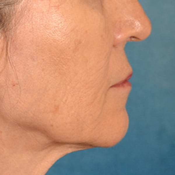 Lip Lift Before & After Gallery - Patient 796520 - Image 7