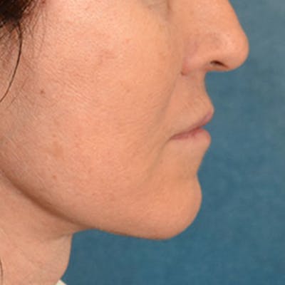 Lip Lift Before & After Gallery - Patient 796520 - Image 8