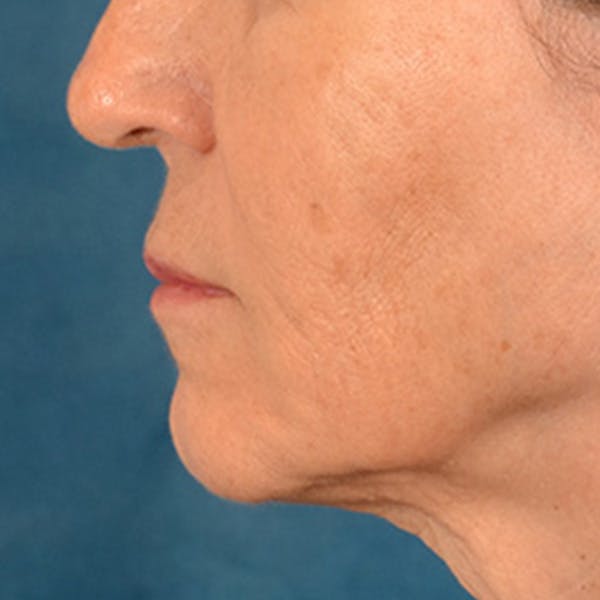 Lip Lift Before & After Gallery - Patient 796520 - Image 9