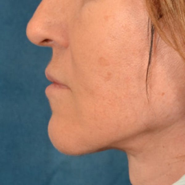 Lip Lift Before & After Gallery - Patient 796520 - Image 10
