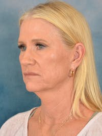 Deep Plane Facelift Before & After Gallery - Patient 254394 - Image 1