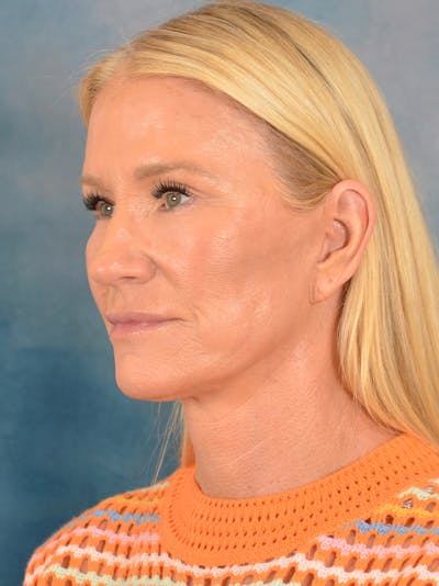 Deep Plane Facelift Before & After Gallery - Patient 254394 - Image 2