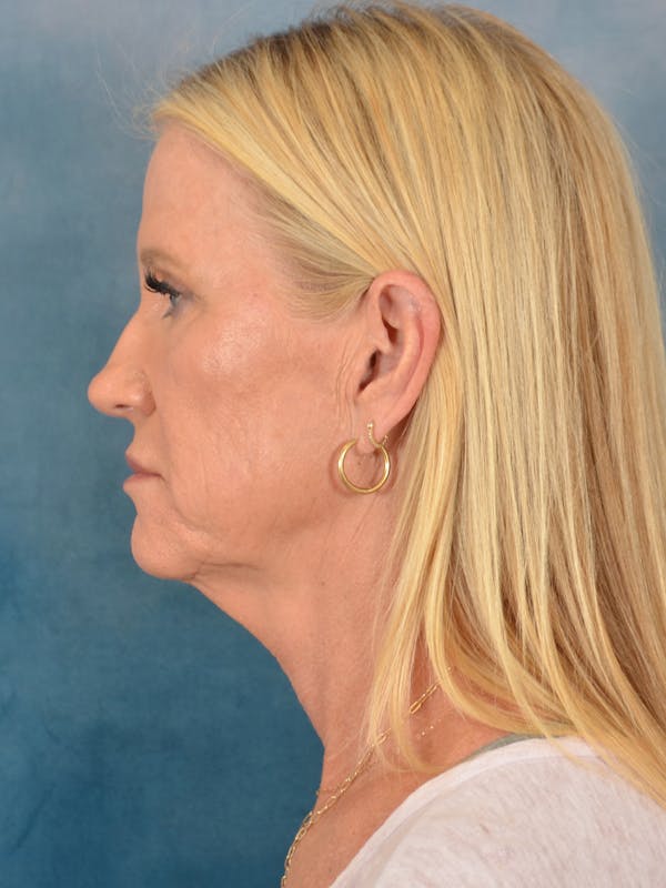 Deep Plane Facelift Before & After Gallery - Patient 254394 - Image 5
