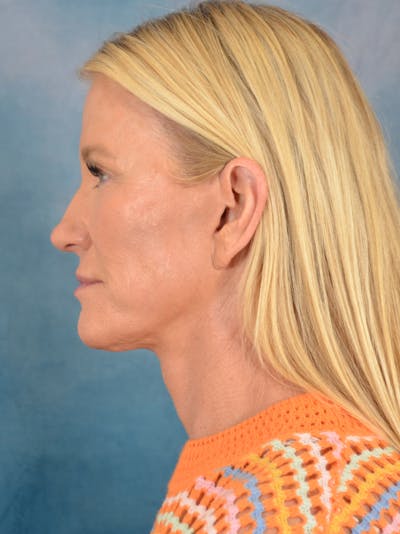 Laser Skin Resurfacing Before & After Gallery - Patient 290222 - Image 6