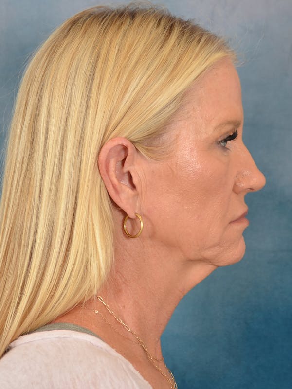 Laser Skin Resurfacing Before & After Gallery - Patient 290222 - Image 7