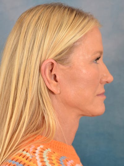 Deep Plane Facelift Before & After Gallery - Patient 254394 - Image 8