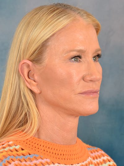 Deep Plane Facelift Before & After Gallery - Patient 254394 - Image 10