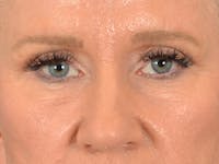 Eyelid Lift Before & After Gallery - Patient 359248 - Image 1
