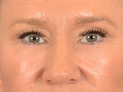 Eyelid Lift Before & After Gallery - Patient 359248 - Image 2