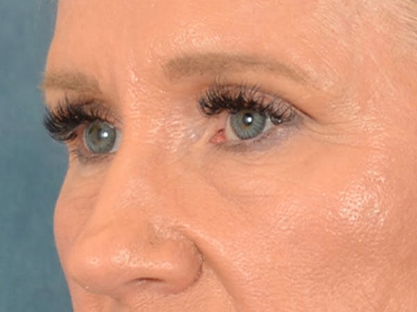 Eyelid Lift Before & After Gallery - Patient 359248 - Image 3