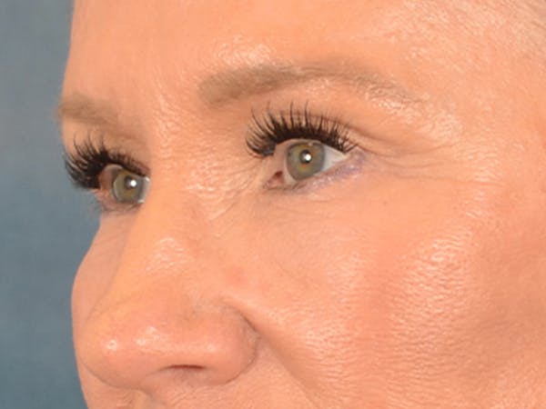 Eyelid Lift Before & After Gallery - Patient 359248 - Image 4