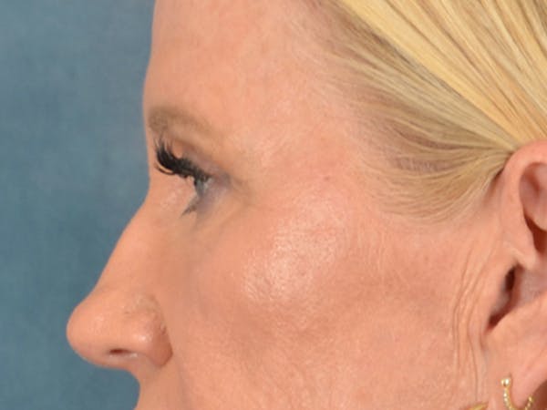 Eyelid Lift Before & After Gallery - Patient 359248 - Image 5