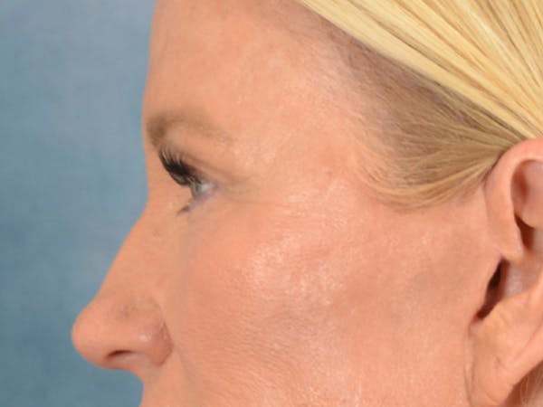 Eyelid Lift Before & After Gallery - Patient 359248 - Image 6