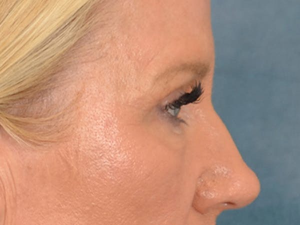 Eyelid Lift Before & After Gallery - Patient 359248 - Image 7