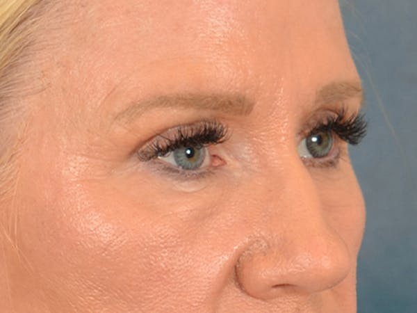 Eyelid Lift Before & After Gallery - Patient 359248 - Image 9