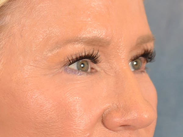 Eyelid Lift Before & After Gallery - Patient 359248 - Image 10