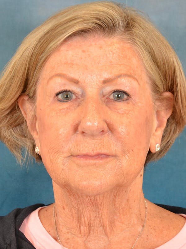 Brow Lift Before & After Gallery - Patient 457452 - Image 1