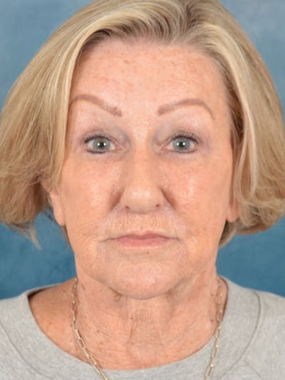Brow Lift Before & After Gallery - Patient 457452 - Image 2