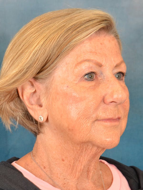 Brow Lift Before & After Gallery - Patient 457452 - Image 7