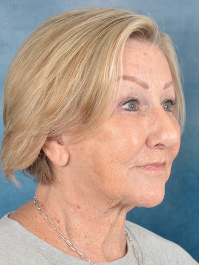 Deep Plane Facelift Before & After Gallery - Patient 259950 - Image 6