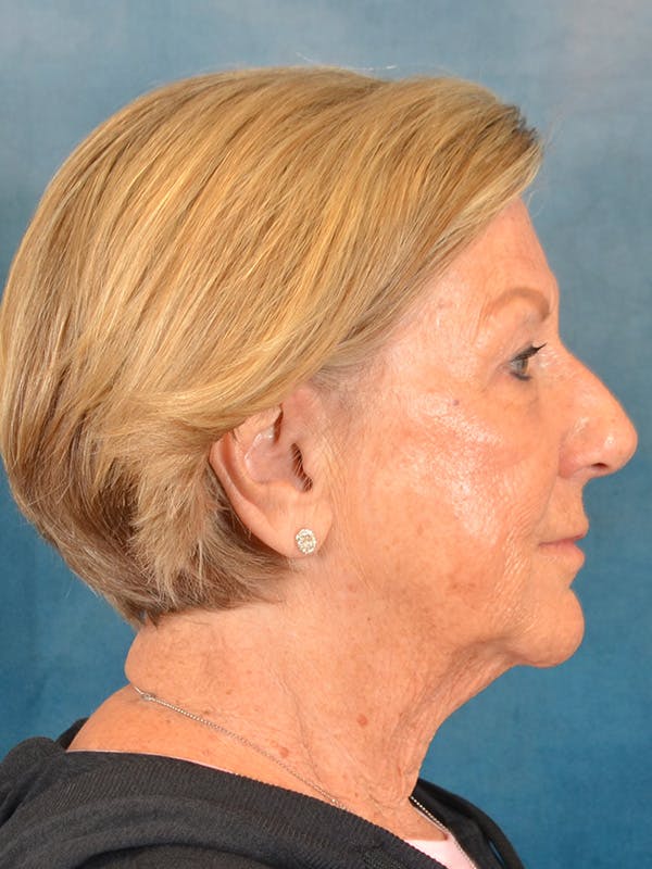 Brow Lift Before & After Gallery - Patient 457452 - Image 9
