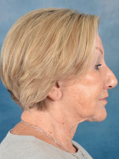 Brow Lift Before & After Gallery - Patient 457452 - Image 10