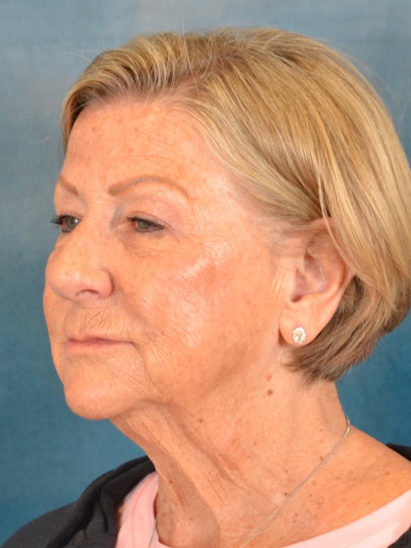 Brow Lift Before & After Gallery - Patient 457452 - Image 3