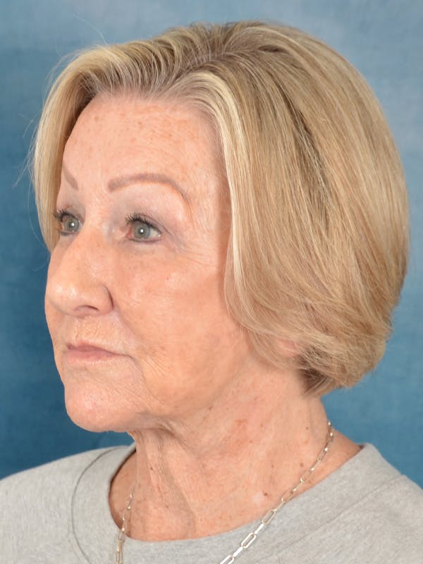 Brow Lift Before & After Gallery - Patient 457452 - Image 4