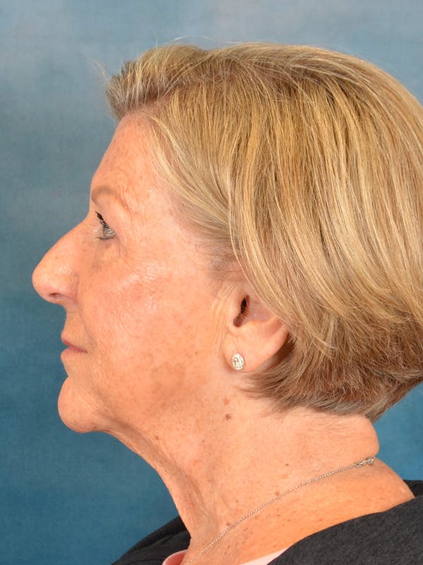 Deep Plane Facelift Before & After Gallery - Patient 259950 - Image 3