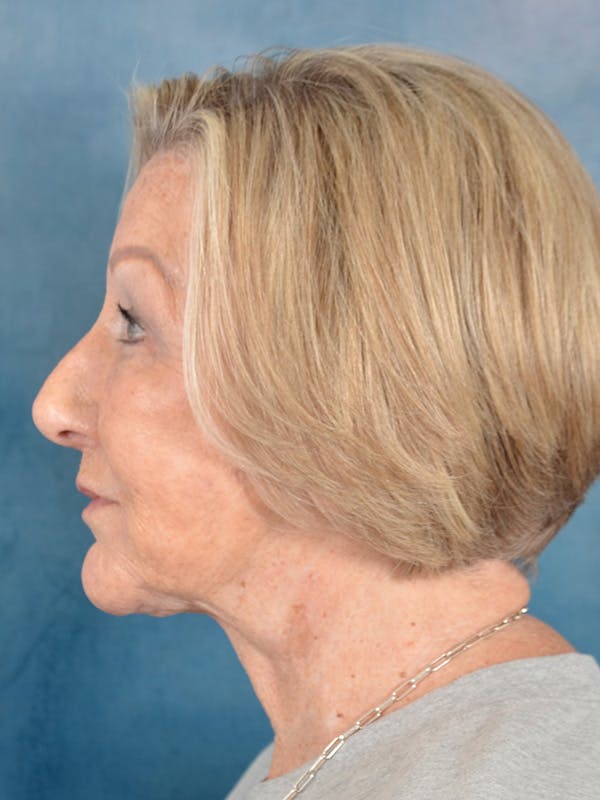 Deep Plane Facelift Before & After Gallery - Patient 259950 - Image 4