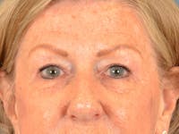 Eyelid Lift Before & After Gallery - Patient 293080 - Image 1