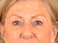 Eyelid Lift Before & After Gallery - Patient 293080 - Image 1