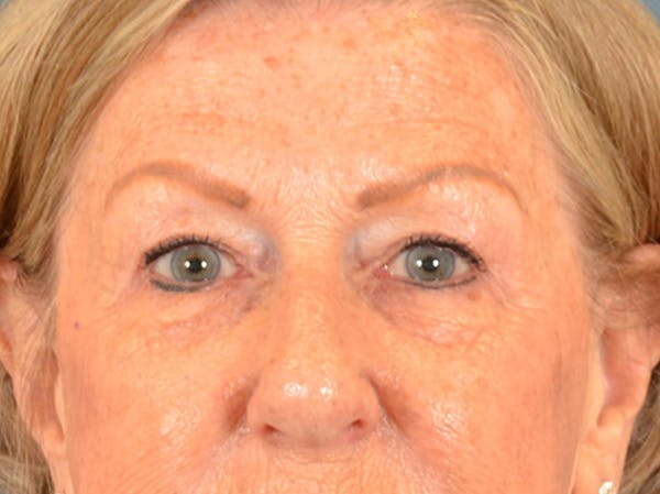 Eyelid Lift Before & After Gallery - Patient 293080 - Image 1