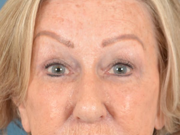 Eyelid Lift Before & After Gallery - Patient 293080 - Image 2