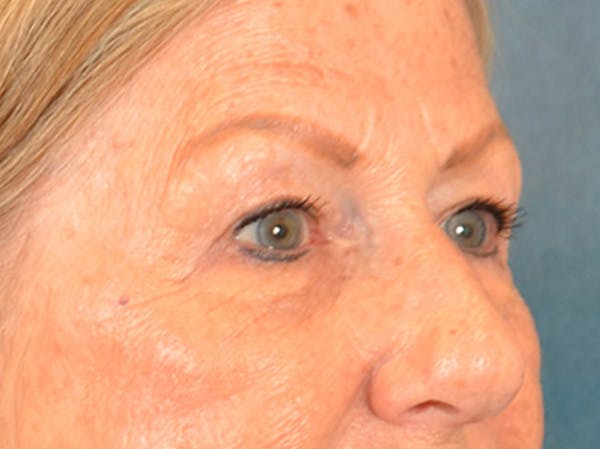 Eyelid Lift Before & After Gallery - Patient 293080 - Image 3