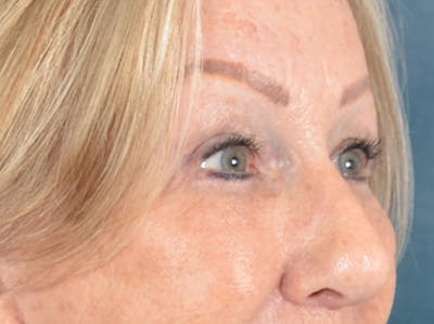 Eyelid Lift Before & After Gallery - Patient 293080 - Image 4