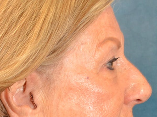 Eyelid Lift Before & After Gallery - Patient 293080 - Image 5